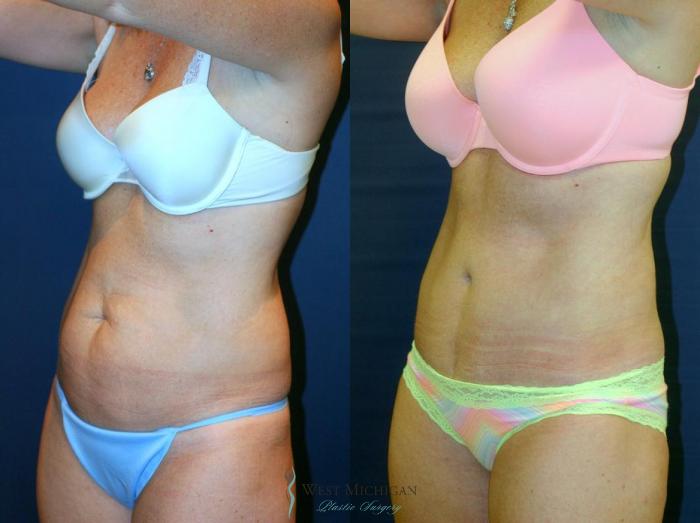 Before & After Tummy Tuck Case 9062 View #3 View in Kalamazoo & Grand Rapids, Michigan