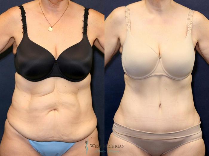 Before & After Tummy Tuck Case 9063 View #1 View in Kalamazoo & Grand Rapids, Michigan
