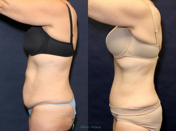 Before & After Tummy Tuck Case 9063 View #2 View in Kalamazoo & Grand Rapids, Michigan