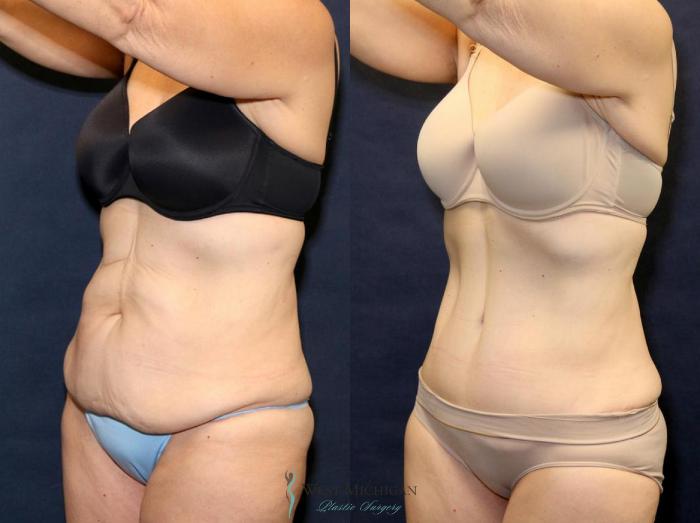 Before & After Tummy Tuck Case 9063 View #3 View in Kalamazoo & Grand Rapids, Michigan