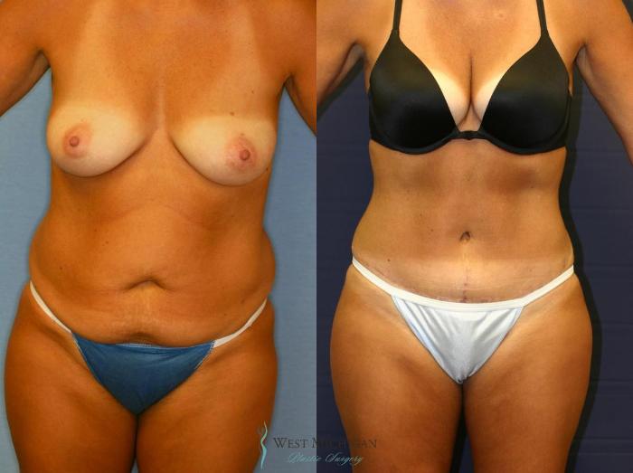 Before & After Tummy Tuck Case 9064 View #1 View in Portage, Kalamazoo, Battle Creek, Michigan