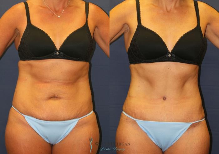 Before & After Tummy Tuck Case 9326 Front View in Kalamazoo & Grand Rapids, Michigan