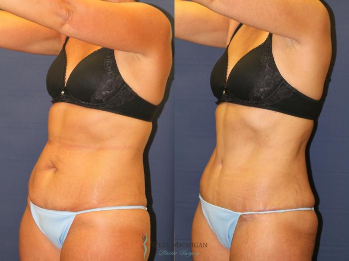 Before & After Tummy Tuck Case 9326 Left Oblique View in Kalamazoo & Grand Rapids, Michigan
