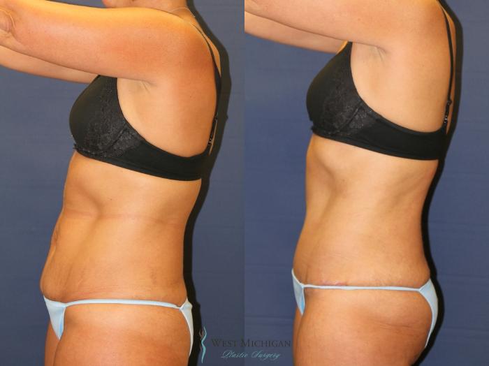 Before & After Tummy Tuck Case 9326 Left Side View in Kalamazoo & Grand Rapids, Michigan