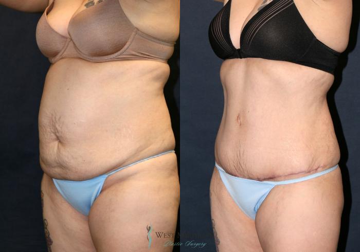 Before & After Tummy Tuck Case 9327 Left Oblique View in Portage, Kalamazoo, Battle Creek, Michigan
