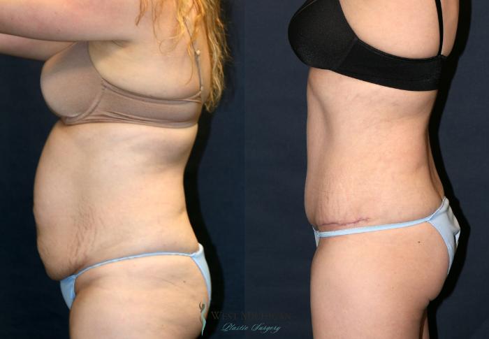 Before & After Tummy Tuck Case 9327 Left Side View in Portage, Kalamazoo, Battle Creek, Michigan
