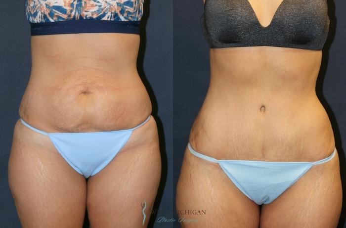 Before & After Tummy Tuck Case 9330 Front View in Kalamazoo & Grand Rapids, Michigan