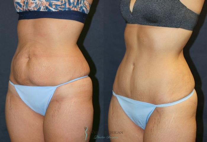 Before & After Tummy Tuck Case 9330 Left Oblique View in Kalamazoo & Grand Rapids, Michigan