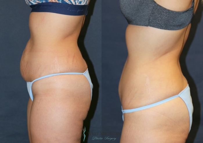 Before & After Tummy Tuck Case 9330 Left Side View in Kalamazoo & Grand Rapids, Michigan