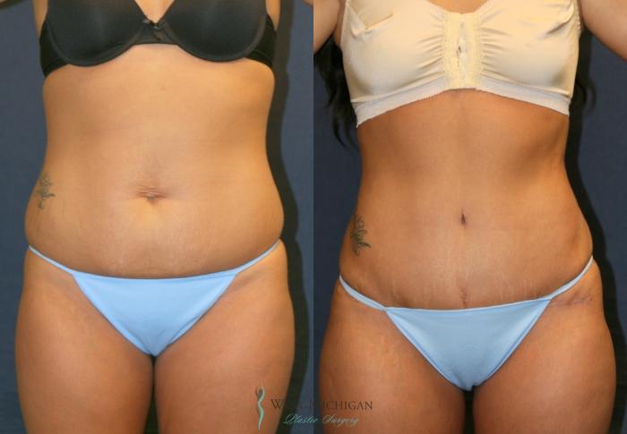Before & After Tummy Tuck Case 9331 Front View in Kalamazoo & Grand Rapids, Michigan