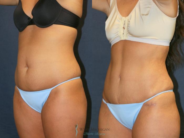 Before & After Tummy Tuck Case 9331 Left Oblique View in Kalamazoo & Grand Rapids, Michigan