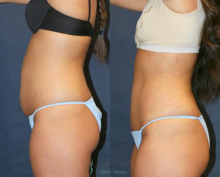 Before & After Tummy Tuck Case 9331 Left Side View in Kalamazoo & Grand Rapids, Michigan