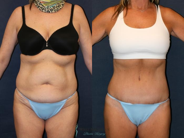 Before & After Tummy Tuck Case 9338 Front View in Portage, Kalamazoo, Battle Creek, Michigan