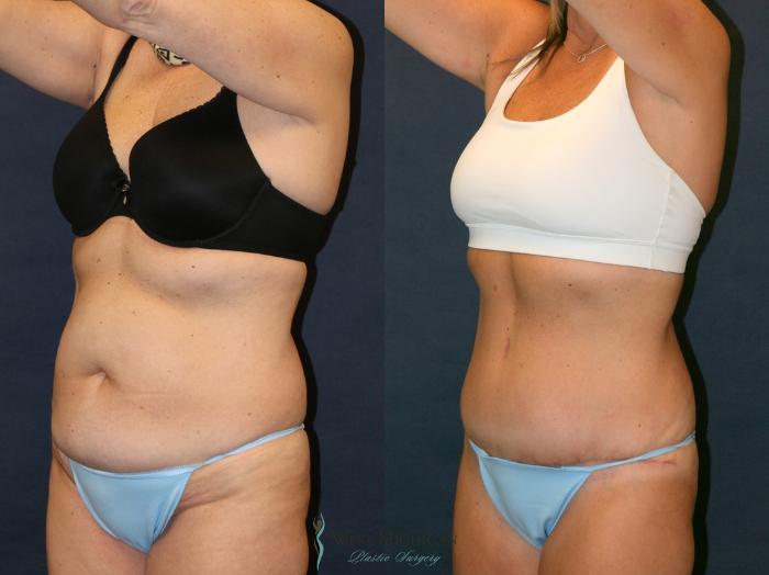 Before & After Tummy Tuck Case 9338 Left Oblique View in Portage, Kalamazoo, Battle Creek, Michigan