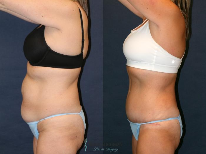 Before & After Tummy Tuck Case 9338 Left Side View in Portage, Kalamazoo, Battle Creek, Michigan