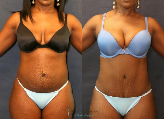 Before & After Tummy Tuck Case 9339 Front View in Kalamazoo & Grand Rapids, Michigan