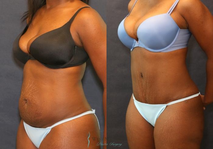 Before & After Tummy Tuck Case 9339 Left Oblique View in Kalamazoo & Grand Rapids, Michigan