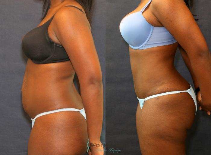 Before & After Tummy Tuck Case 9339 Left Side View in Kalamazoo & Grand Rapids, Michigan