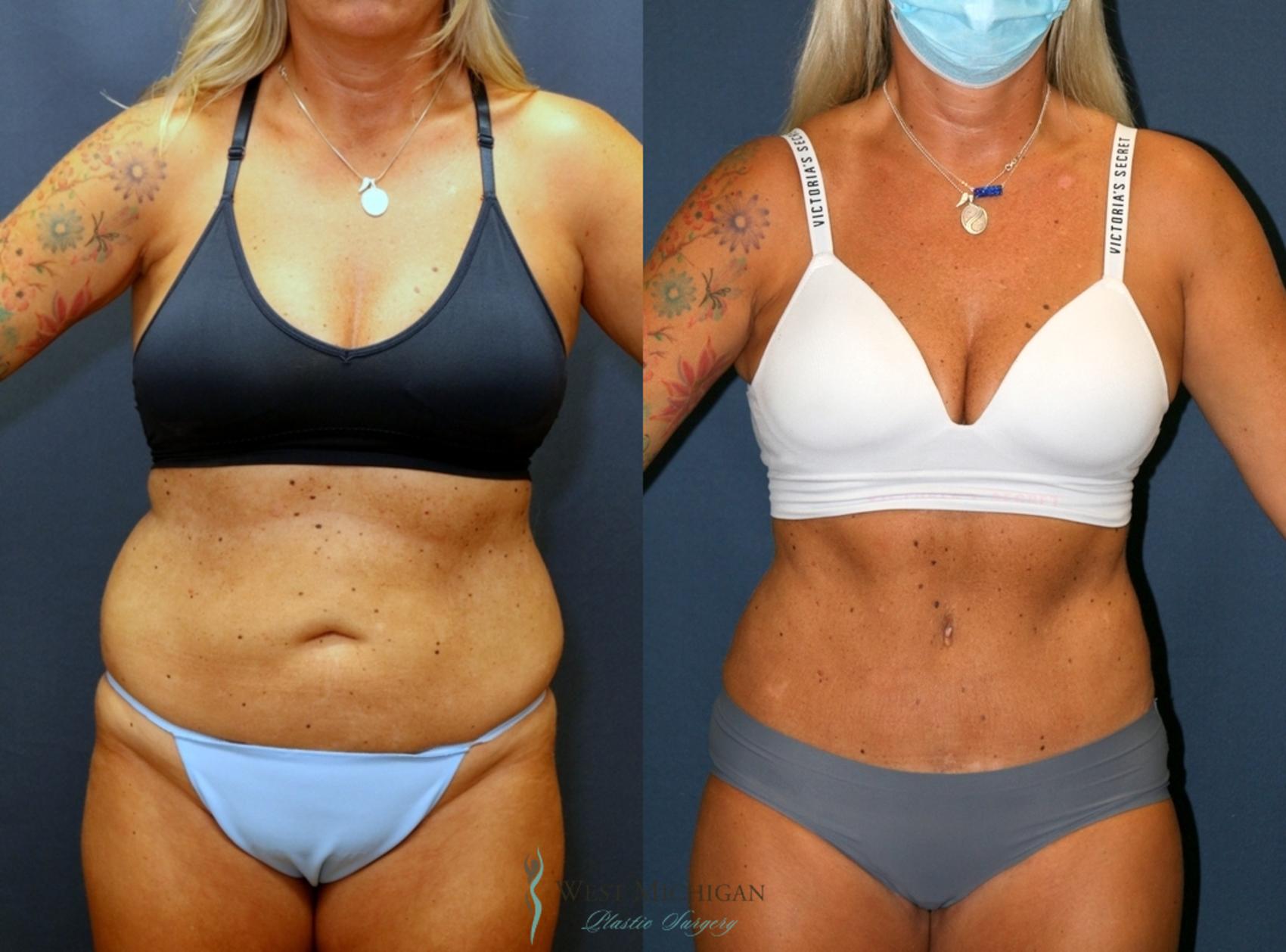 Can a Tummy Tuck Treat Stretch Marks? - Cosmetic Surgeons of Michigan, P.C.