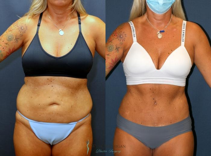 Before & After Tummy Tuck Case 9340 Front View in Portage, Kalamazoo, Battle Creek, Michigan