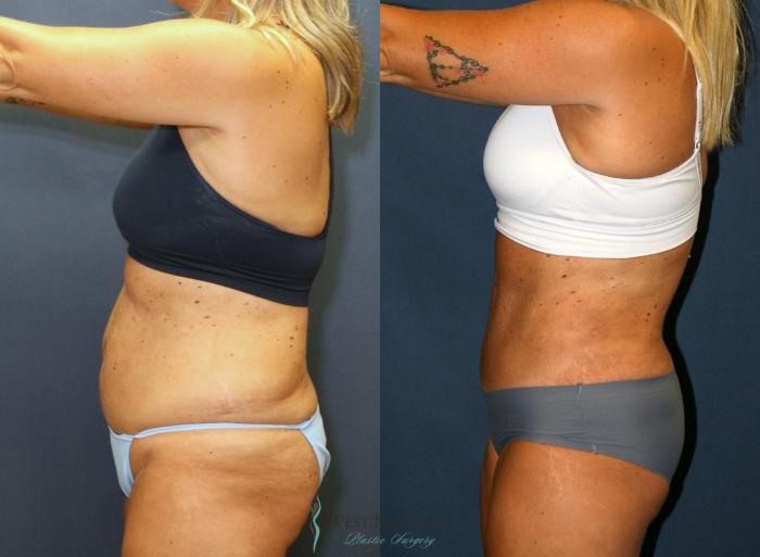 Before & After Tummy Tuck Case 9340 Left Side View in Portage, Kalamazoo, Battle Creek, Michigan