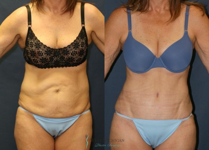 Before & After Tummy Tuck Case 9341 Front View in Kalamazoo & Grand Rapids, Michigan