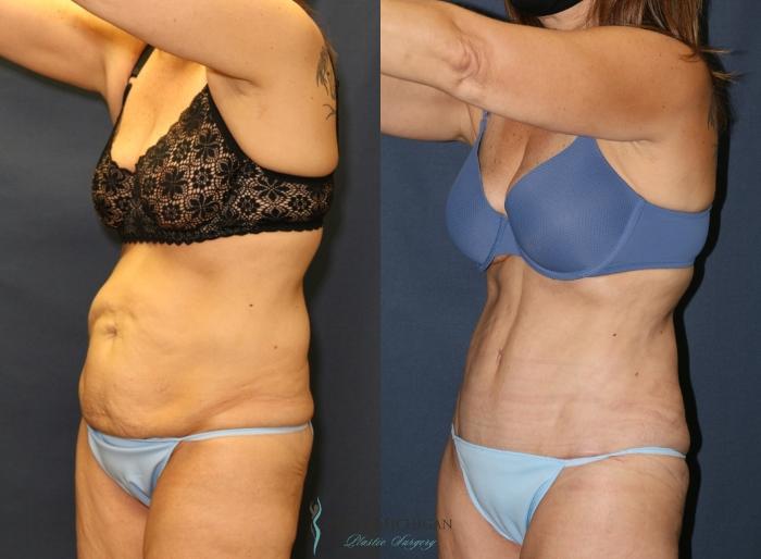 Before & After Tummy Tuck Case 9341 Left Oblique View in Kalamazoo & Grand Rapids, Michigan