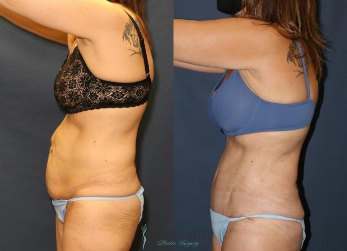 Before & After Tummy Tuck Case 9341 Left Side View in Kalamazoo & Grand Rapids, Michigan