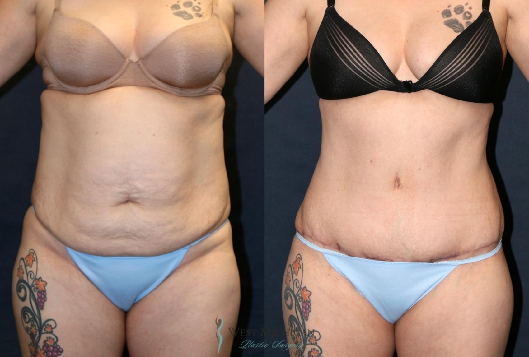 Before & After Tummy Tuck Case 9370 Front View in Kalamazoo & Grand Rapids, Michigan