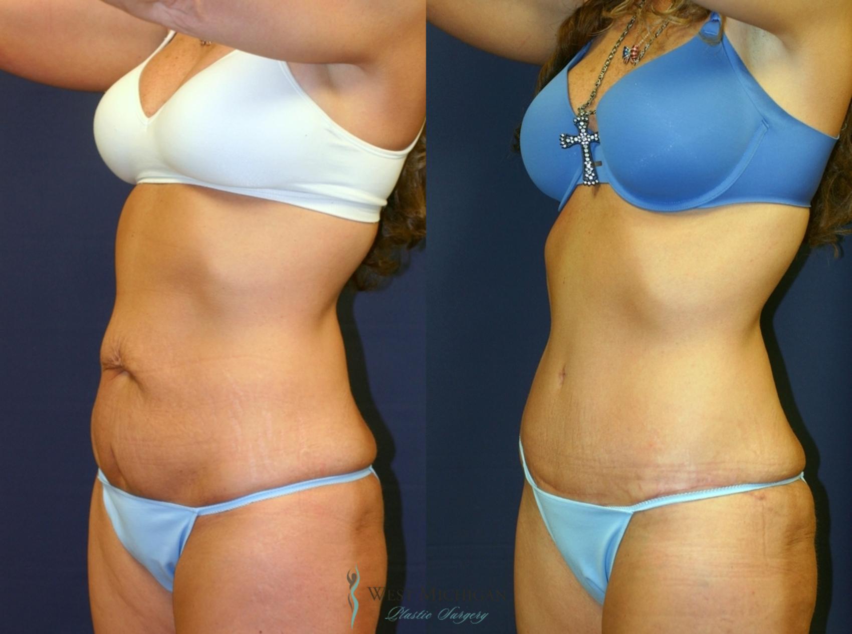 Before & After Tummy Tuck Case 9372 Left Oblique View in Kalamazoo & Grand Rapids, Michigan