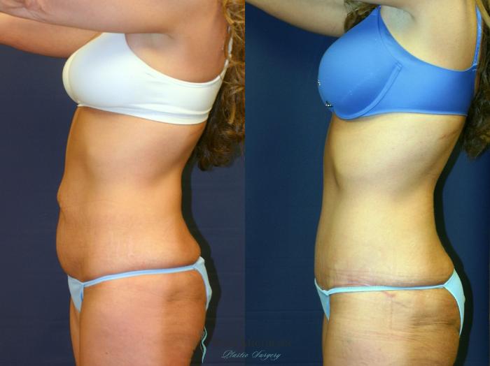 Before & After Tummy Tuck Case 9372 Left Side View in Portage, Kalamazoo, Battle Creek, Michigan