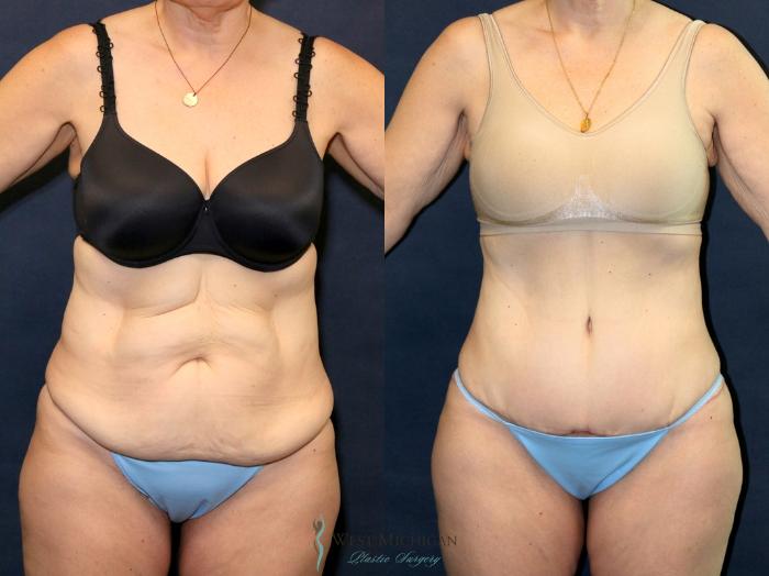 Before & After Tummy Tuck Case 9373 Front View in Portage, Kalamazoo, Battle Creek, Michigan